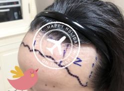 -大麦微针植发全国连锁