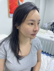 -海涛医疗美容·面部抗衰·注射美鼻