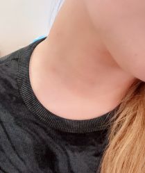 -爱莎扁平疣·汗管瘤·斑痣中心