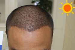 -大麦微针植发丨全国连锁