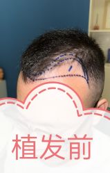 -大麦微针植发全国连锁