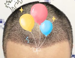 -大麦微针植发全国连锁