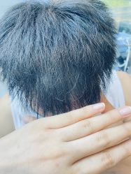 -大麦微针植发全国连锁