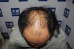 点击看大图 -大麦微针植发丨全国连锁