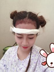 -大麦微针植发丨全国连锁