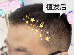 -大麦微针植发全国连锁