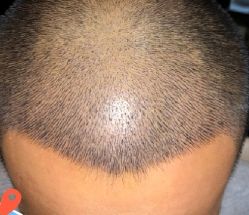 -大麦微针植发丨全国连锁