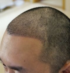 -大麦微针植发全国连锁