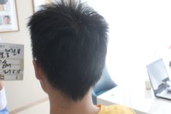 点击看大图 -大麦微针植发丨全国连锁