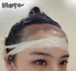 -碧莲盛·不剃发植发