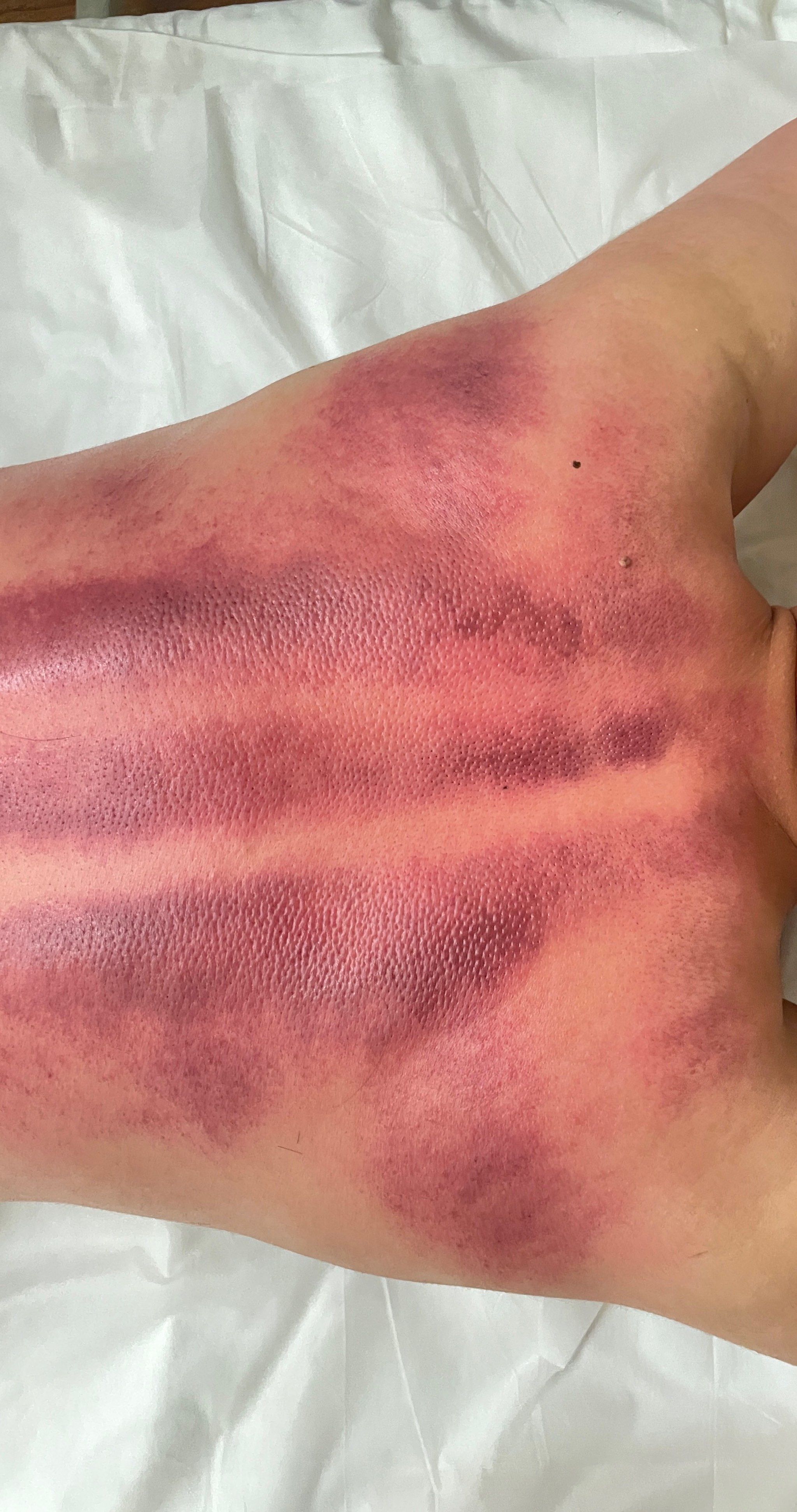 今天你刮痧了吗