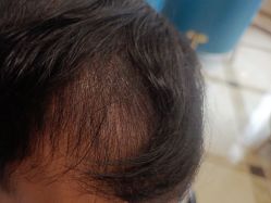 -碧莲盛·不剃发植发