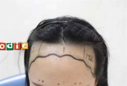 -大麦微针植发全国连锁