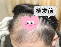 -大麦微针植发全国连锁