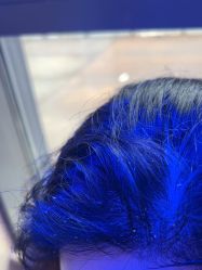 -碧莲盛·不剃发植发