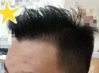 -大麦微针植发丨全国连锁