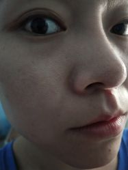 点击看大图 体验后-蕾特恩专业祛痘·皮肤管理