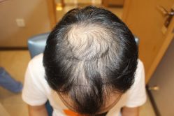 -大麦微针植发丨全国连锁