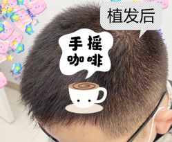-大麦微针植发全国连锁
