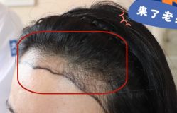 -大麦微针植发全国连锁