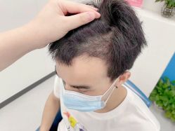 -大麦微针植发全国连锁