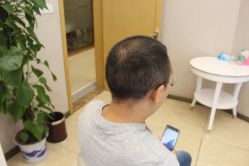 -大麦微针植发丨全国连锁