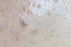 体验前-爱莎扁平疣·汗管瘤·斑痣中心