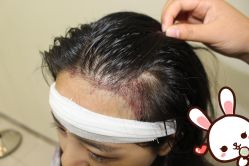 点击看大图 -大麦微针植发丨全国连锁