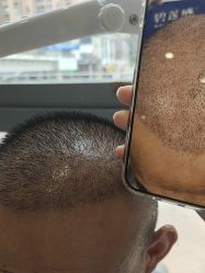 -碧莲盛·不剃发植发