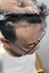 点击看大图 -大麦微针植发全国连锁