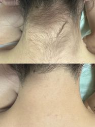 -薇兰专业脱毛连锁机构