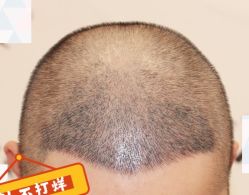 -大麦微针植发全国连锁