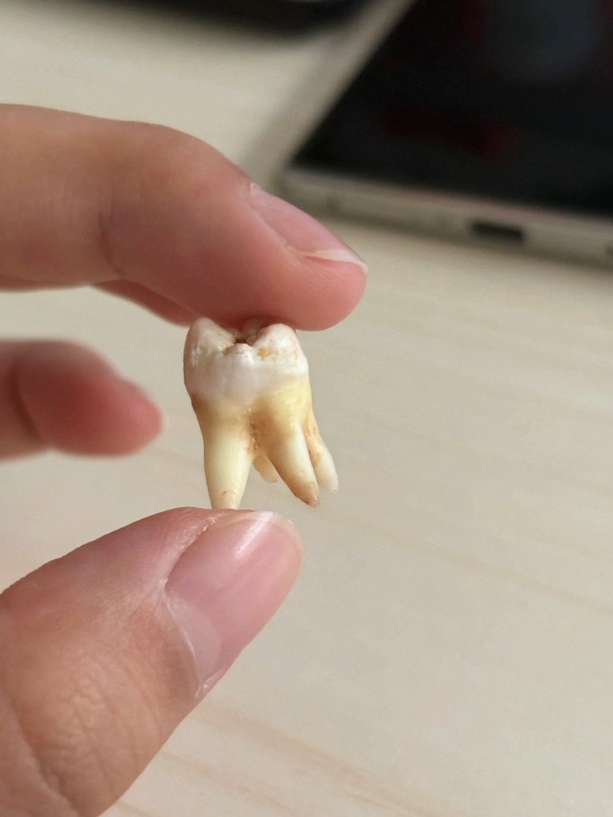 拔了4颗智齿我才知道的事