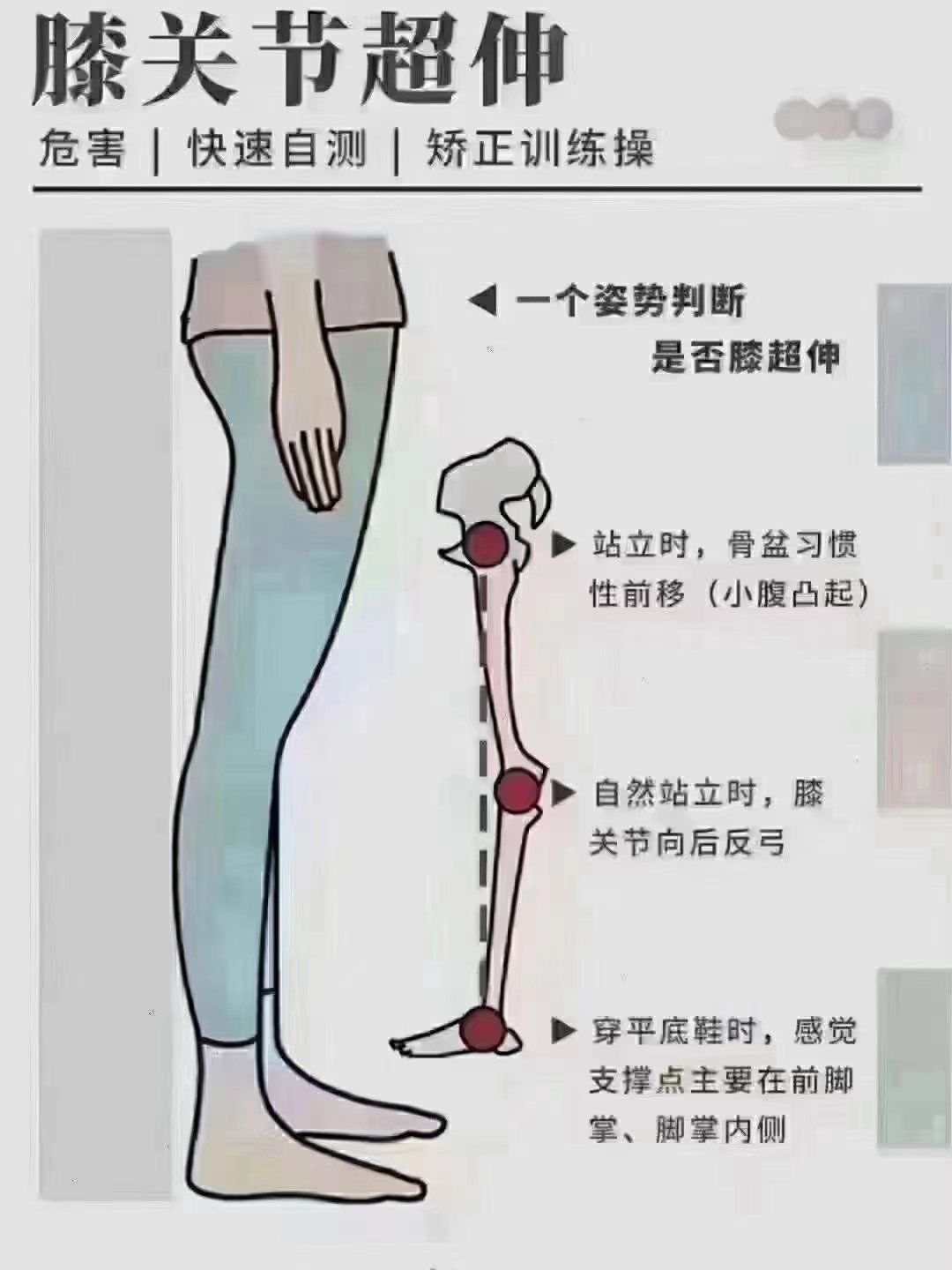 【膝超伸的危害】