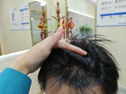 -碧莲盛·不剃发植发