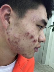 -蕾特恩祛痘•皮肤管理