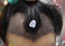 -大麦微针植发全国连锁