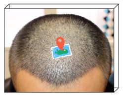 -大麦微针植发全国连锁