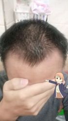 -大麦微针植发丨全国连锁