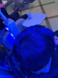 -碧莲盛·不剃发植发