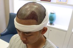 -大麦微针植发丨全国连锁