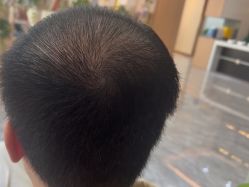 -碧莲盛·不剃发植发