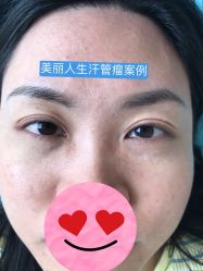 -美丽人生祛斑扁平疣汗管瘤中心