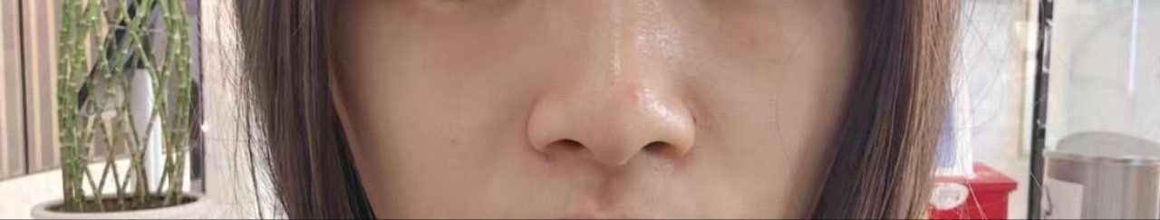 体验前-素美医疗美容·西南眼鼻整形·修复基地