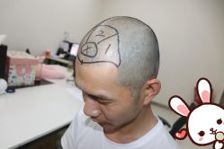 点击看大图 -大麦微针植发丨全国连锁