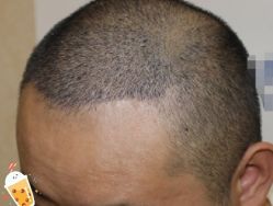 -大麦微针植发丨全国连锁