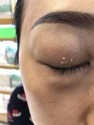 -痣清宫祛斑祛痣连锁店