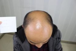 -大麦微针植发丨全国连锁