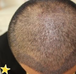 -大麦微针植发丨全国连锁