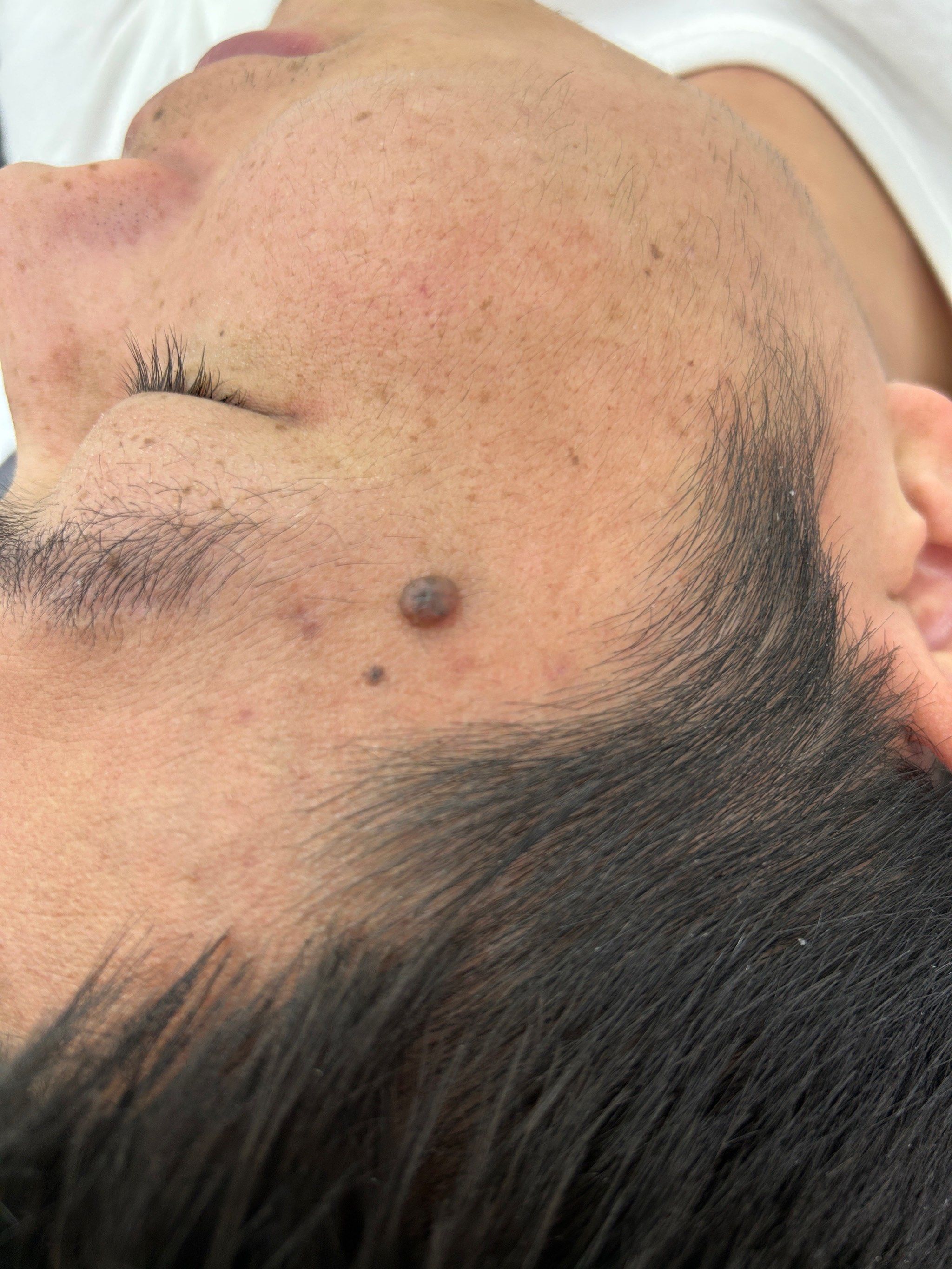 这么大个痣不要留着过年啦